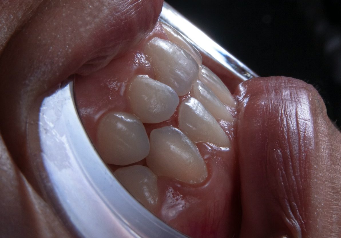a person's mouth with teeth